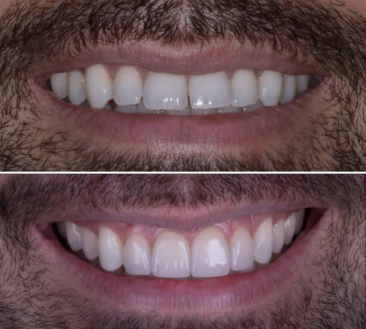 Antes e depois de sorriso masculino com ajuste de forma e proporção dos dentes.