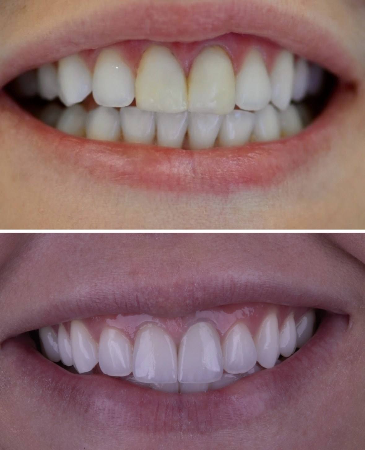 Antes: sorriso com dentes amarelados. Depois: sorriso com dentes claros e naturais.