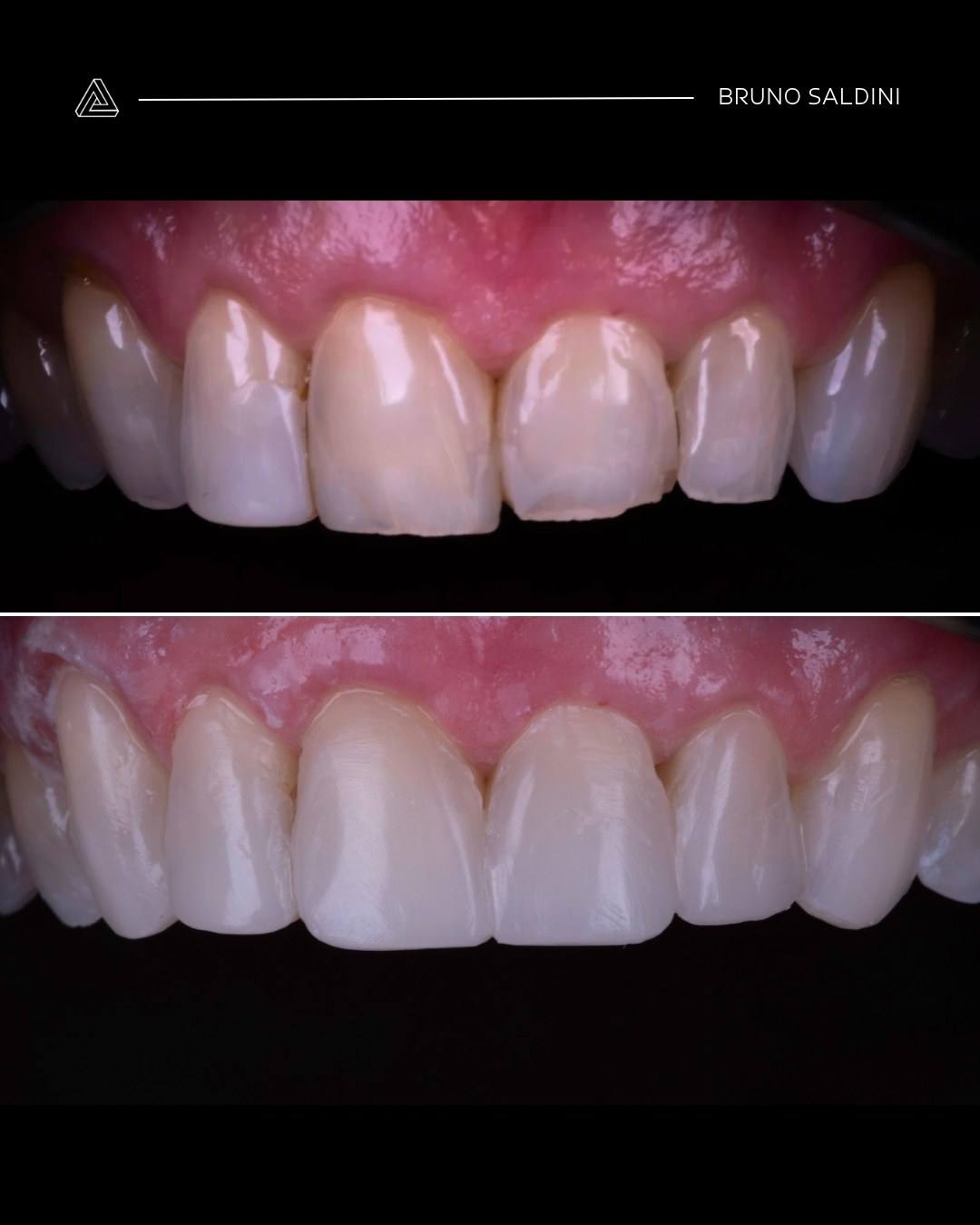 Antes: restaurações com bordas escurecidas. Depois: facetas em porcelana.
