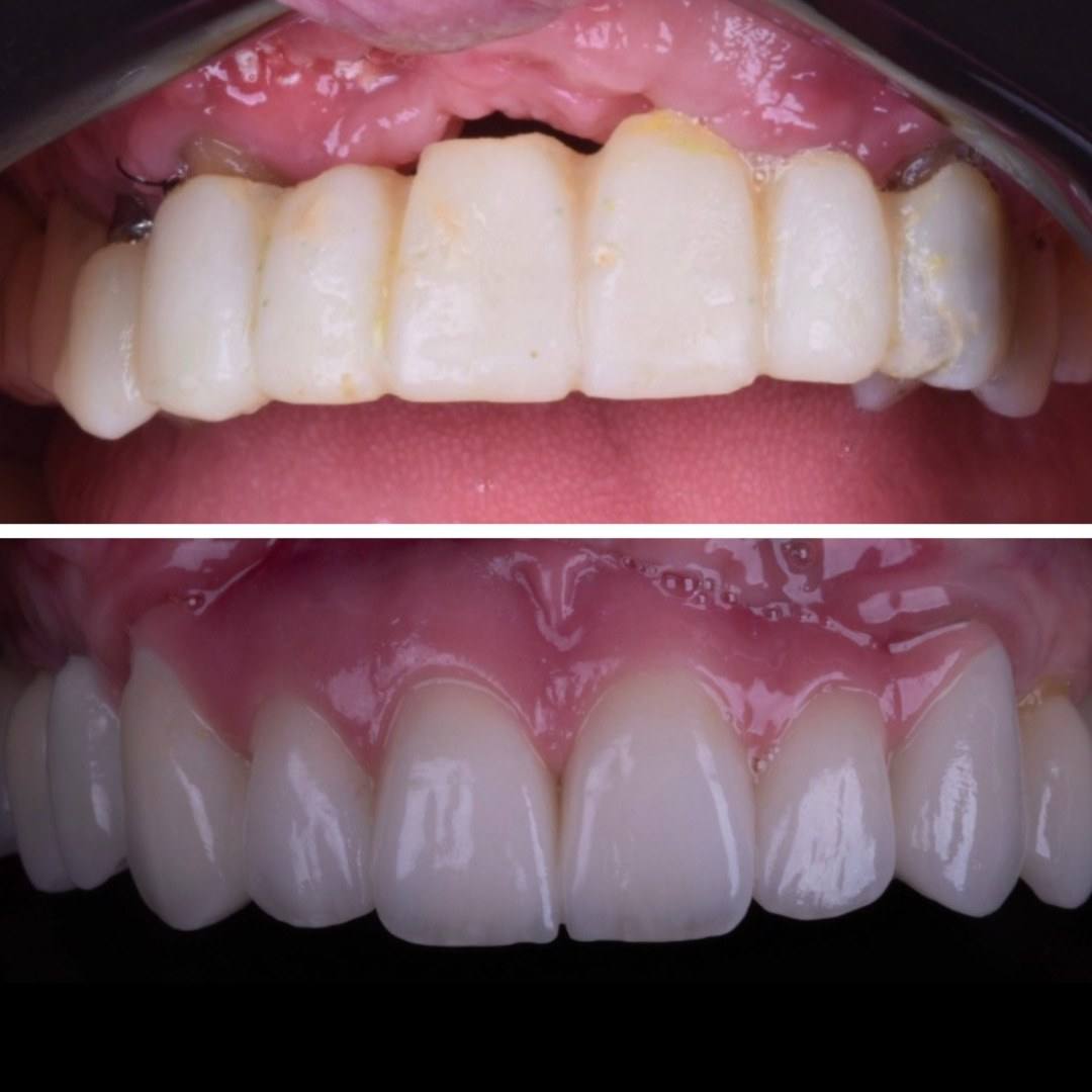 Antes: prótese antiga com gengiva inflamada. Depois: reabilitação com dentes e gengiva saudáveis.