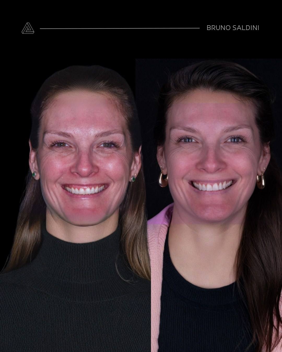 Paciente antes e depois do tratamento, com o rosto como referência para o sorriso.