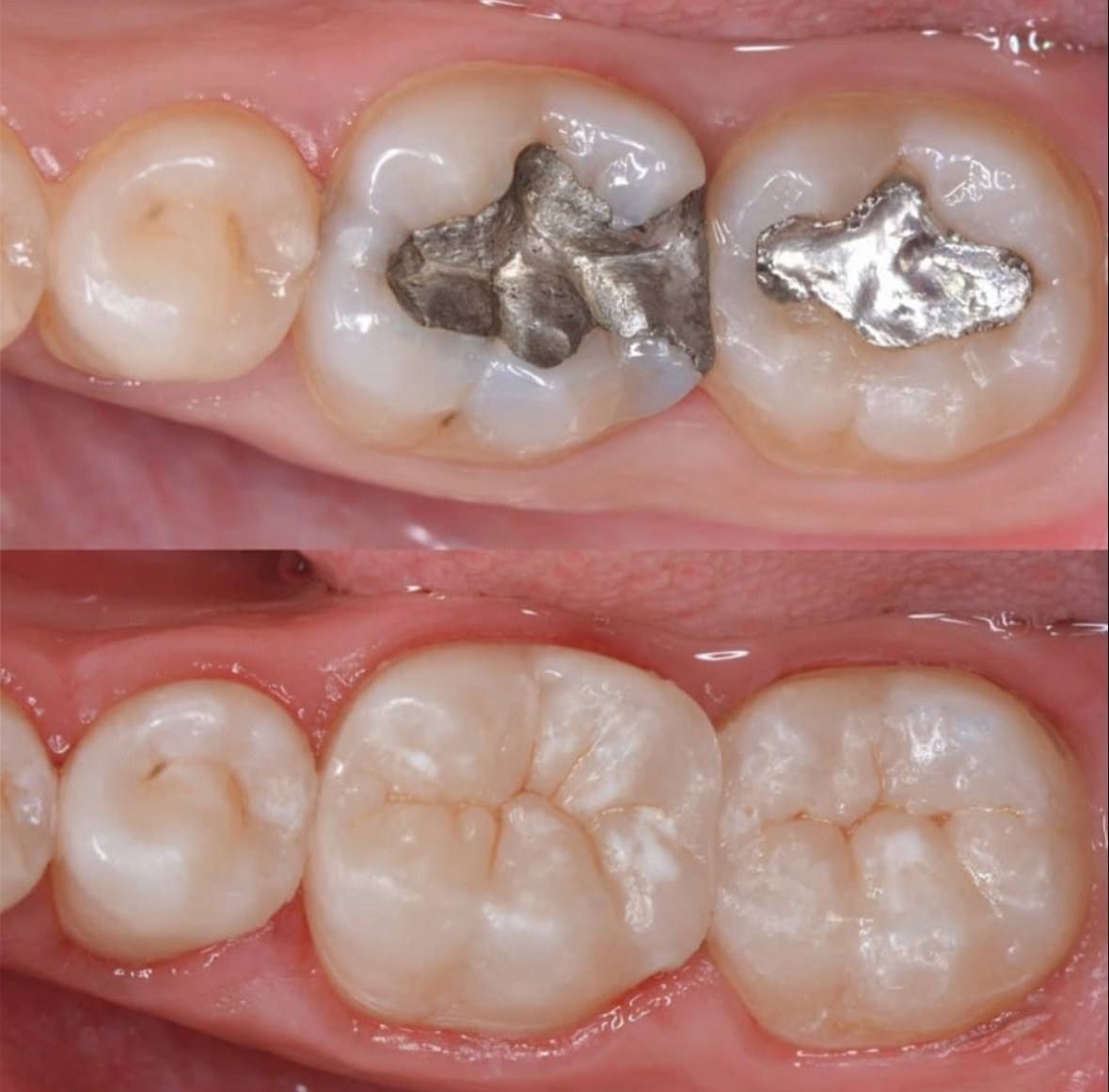 Antes: molares com restaurações metálicas de amálgama. Depois: restaurações da cor do dente.