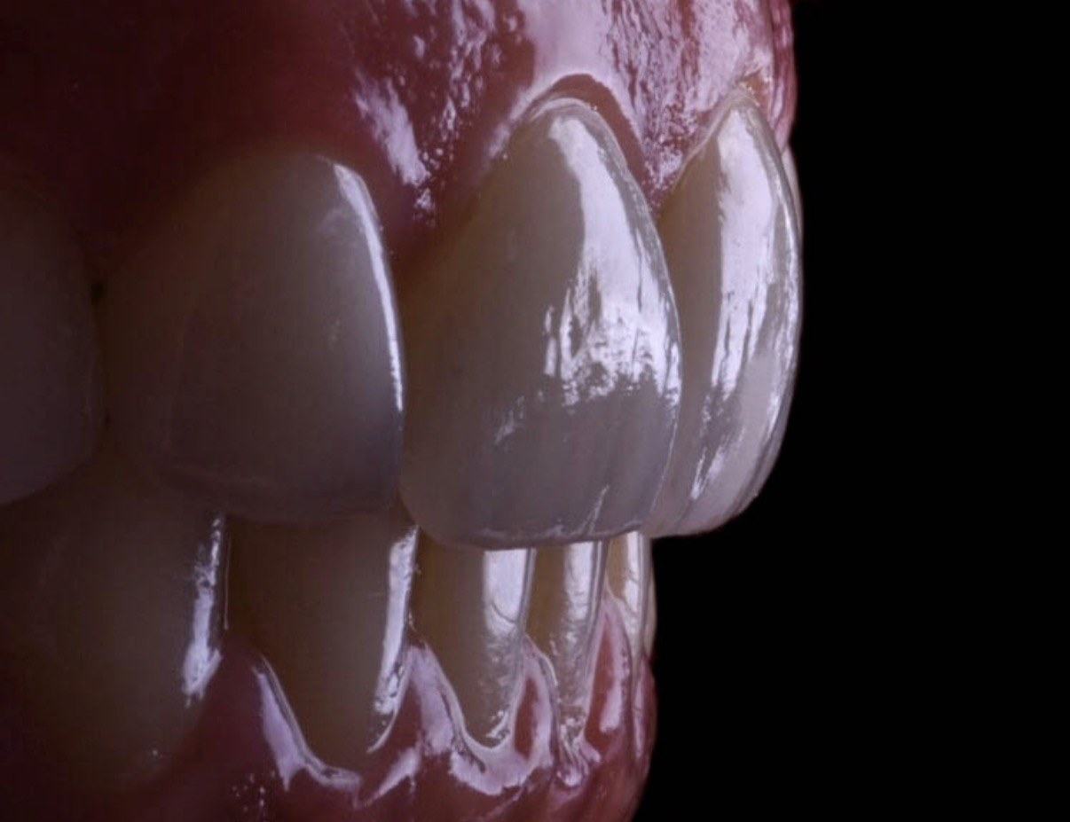 Detalhe aproximado de facetas em porcelana sobre fundo escuro.