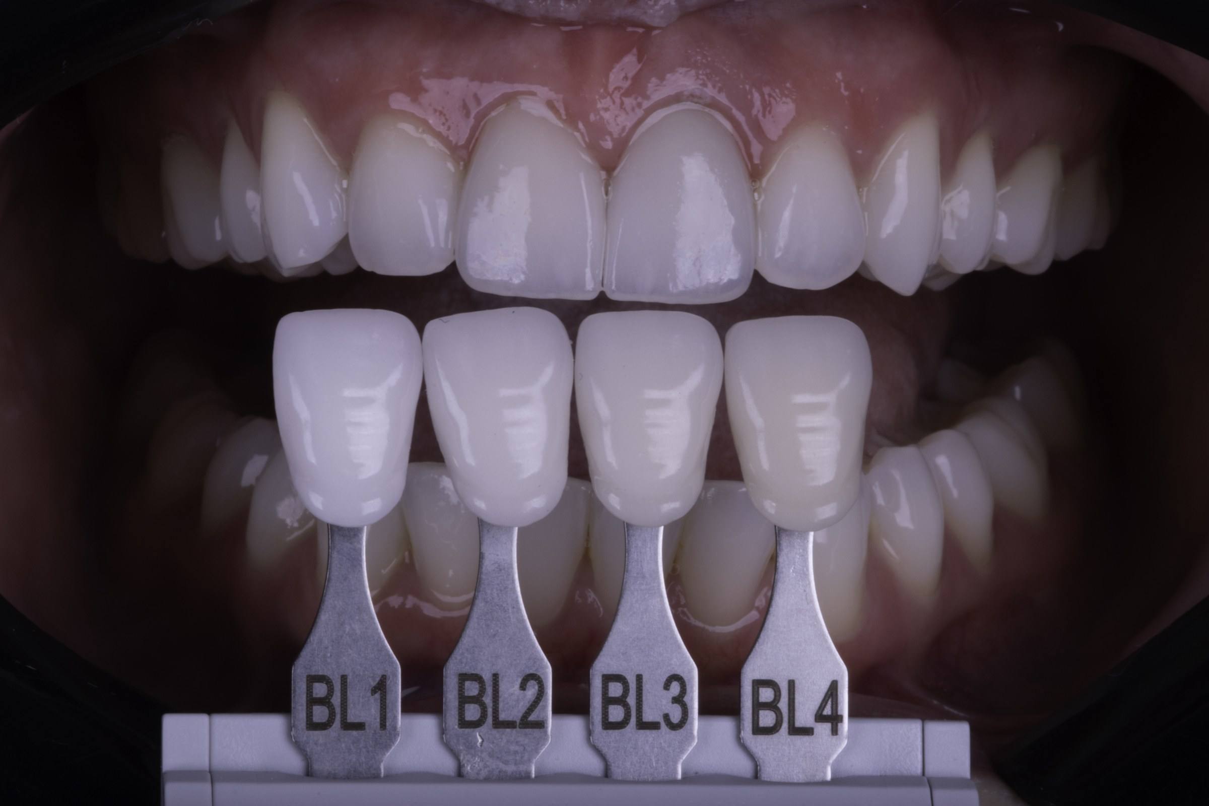 Prova de cor de porcelana, com escalas BL1 a BL4 posicionadas junto aos dentes.