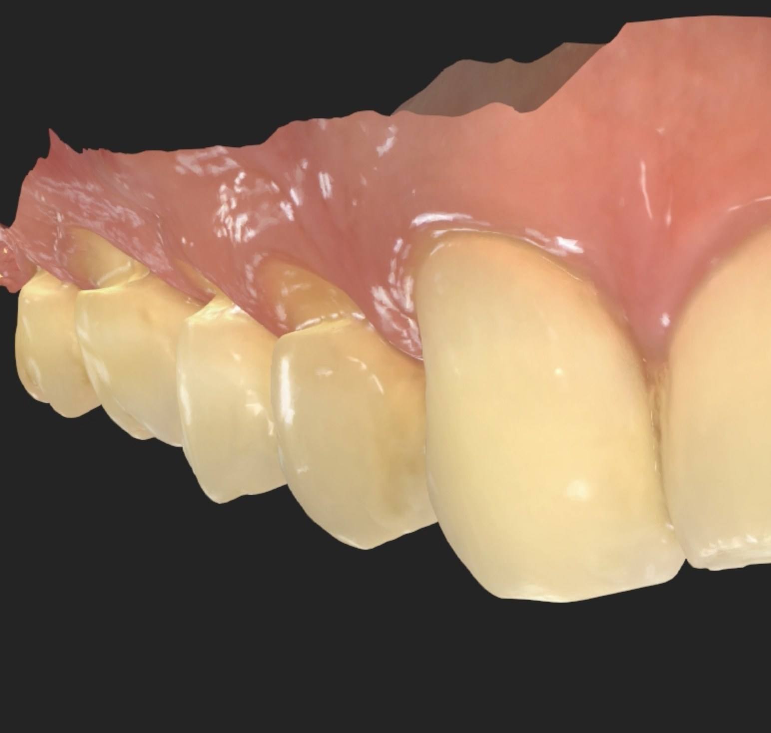 Detalhe de um escaneamento 3D mostrando a superfície dos dentes anteriores.