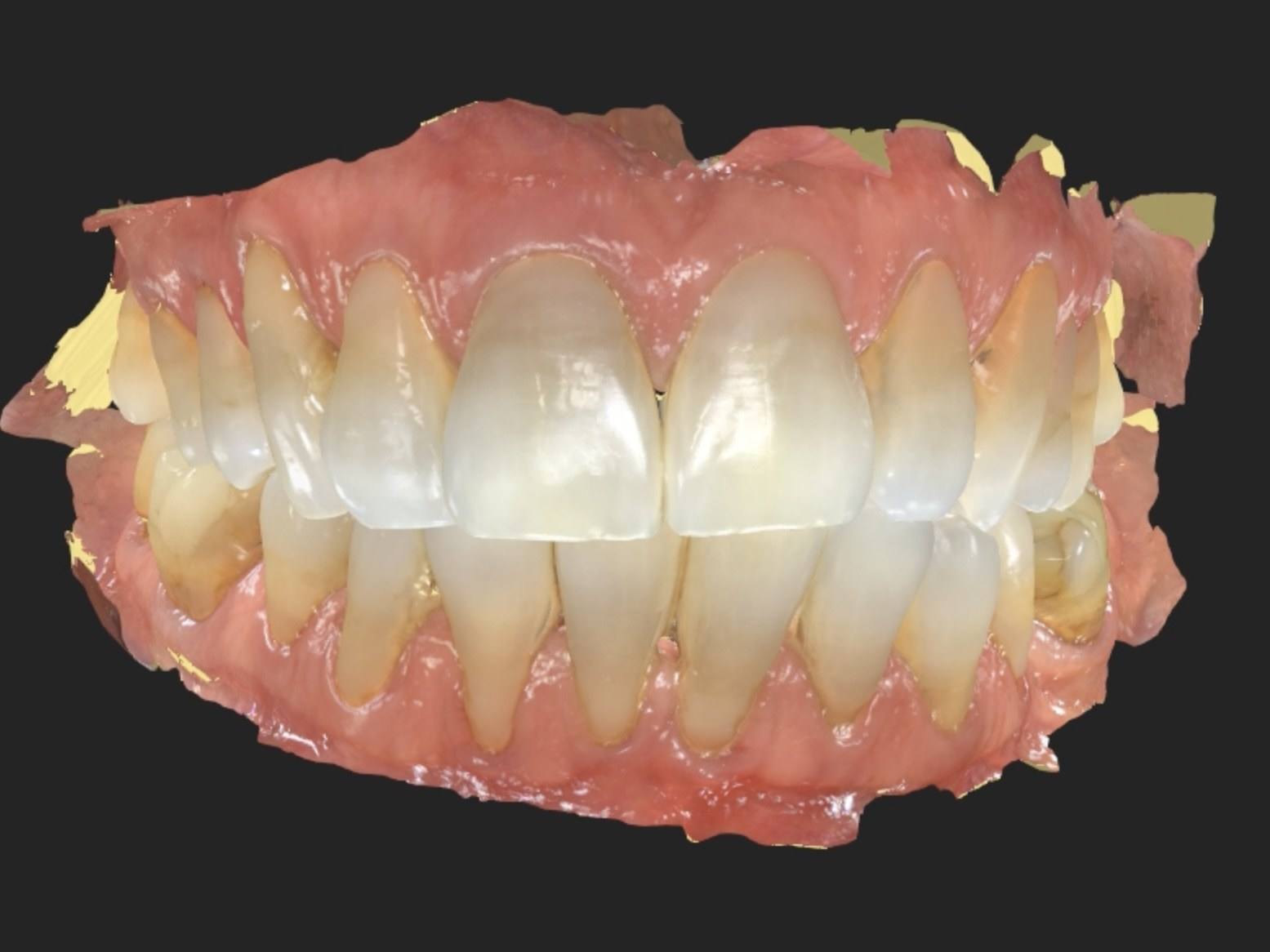 Escaneamento 3D da boca em vista frontal.