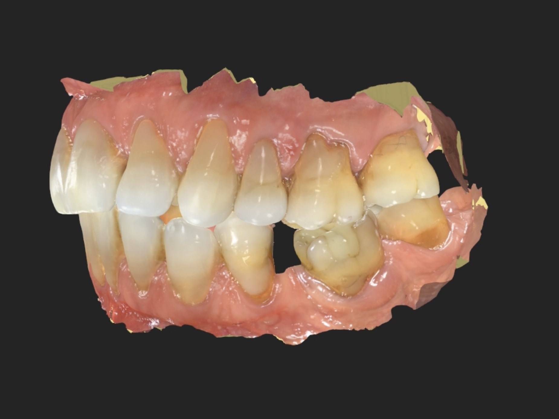 Escaneamento 3D da boca em vista lateral direita.